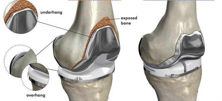 Best Knee Replacement Surgeon in Delhi NCR