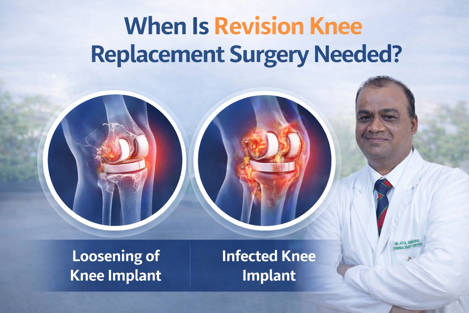 When Is Revision Knee Replacement Surgery Needed?